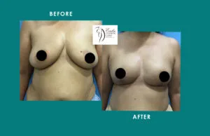 Breast Implant Result Mumbai