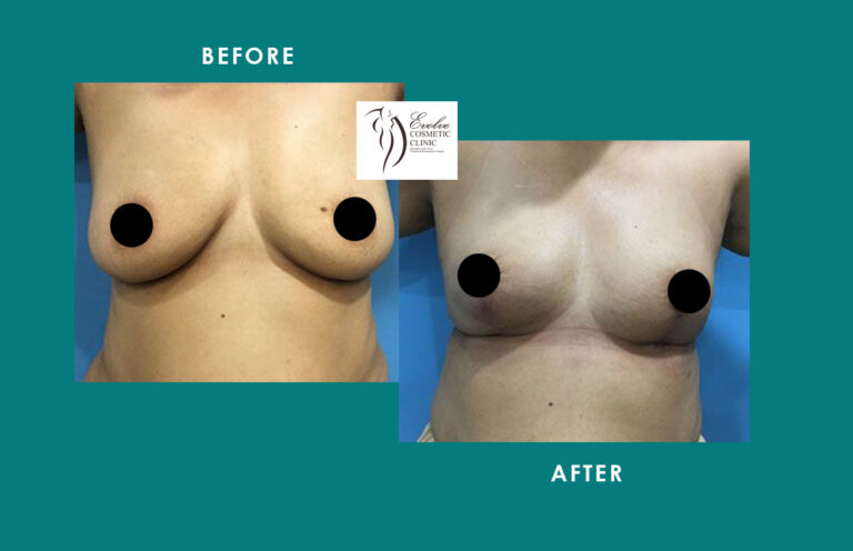 Breast Implant Result Mumbai