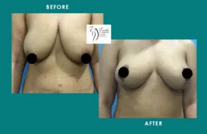 Breast Augmentation