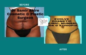Liposuction Surgery Result