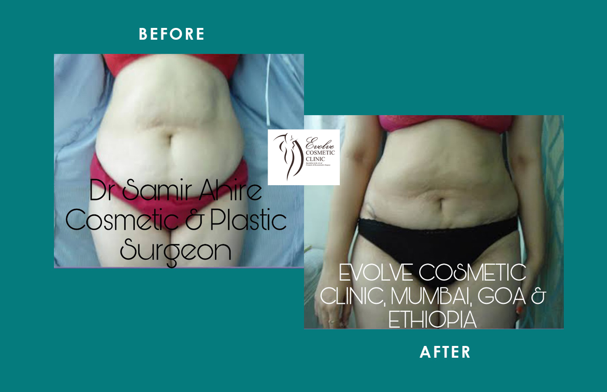 Liposuction Surgery Result