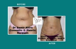 Tummy Tuck Surgery Result