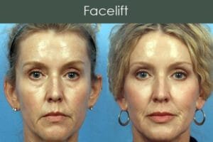 pigmentation treatment