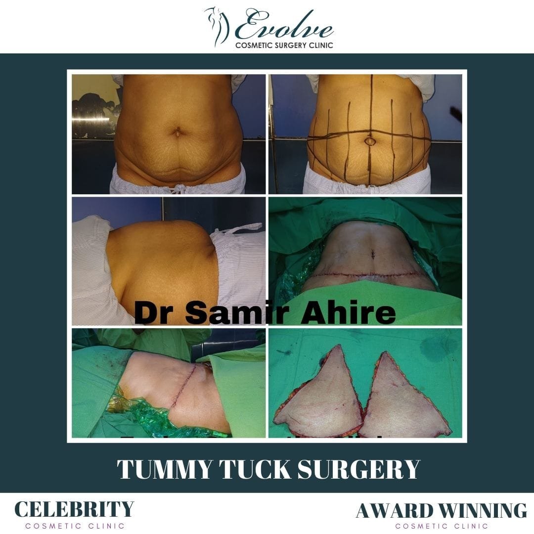 Tummy Tuck Surgery