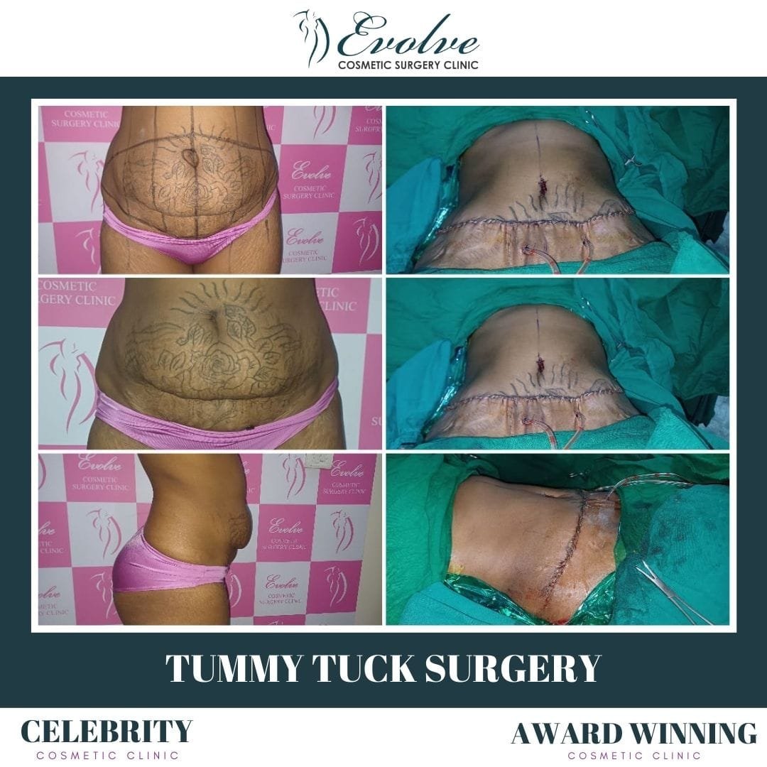 Tummy tuck Surgery Clinic in andheri