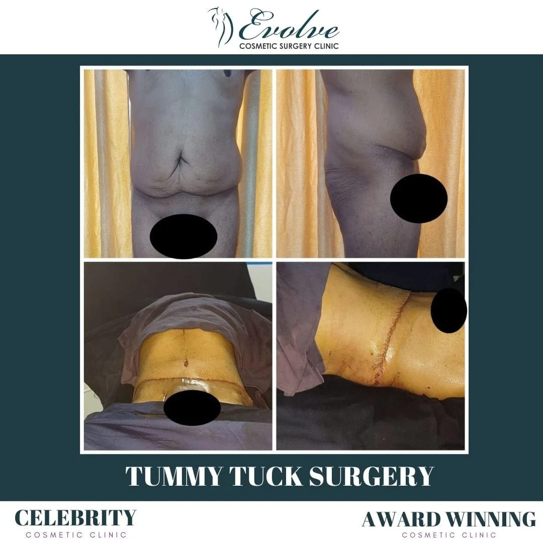 tummy tuck result mumbai