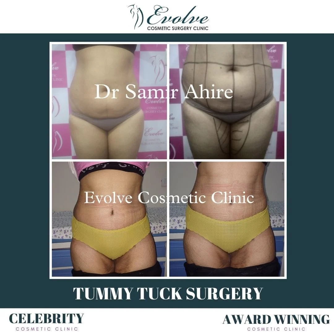 Tummy Tuck Result Mumbai