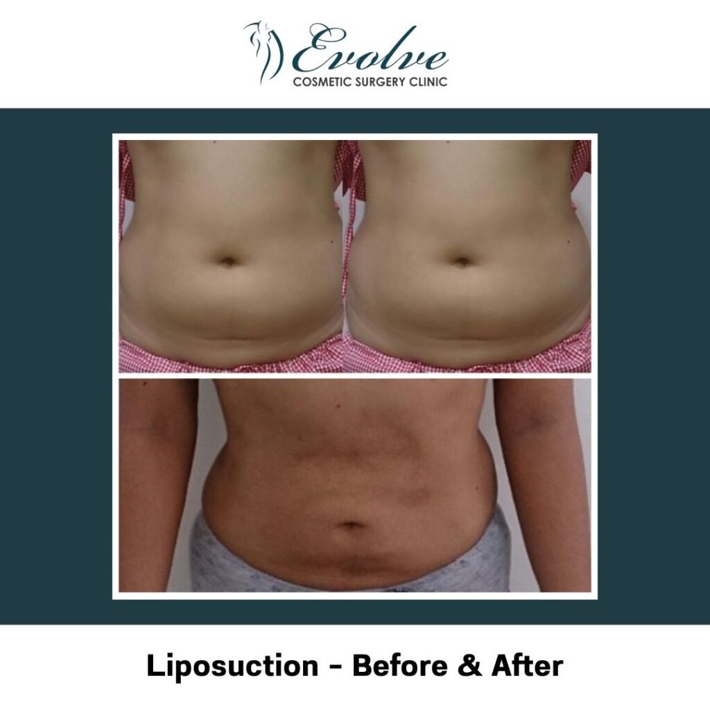 best tummy tuck operation in mumbai