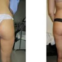 butt lifting